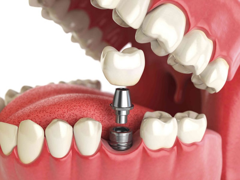 Implanty dentystyczne Bicon – rozmiar ma znaczenie!